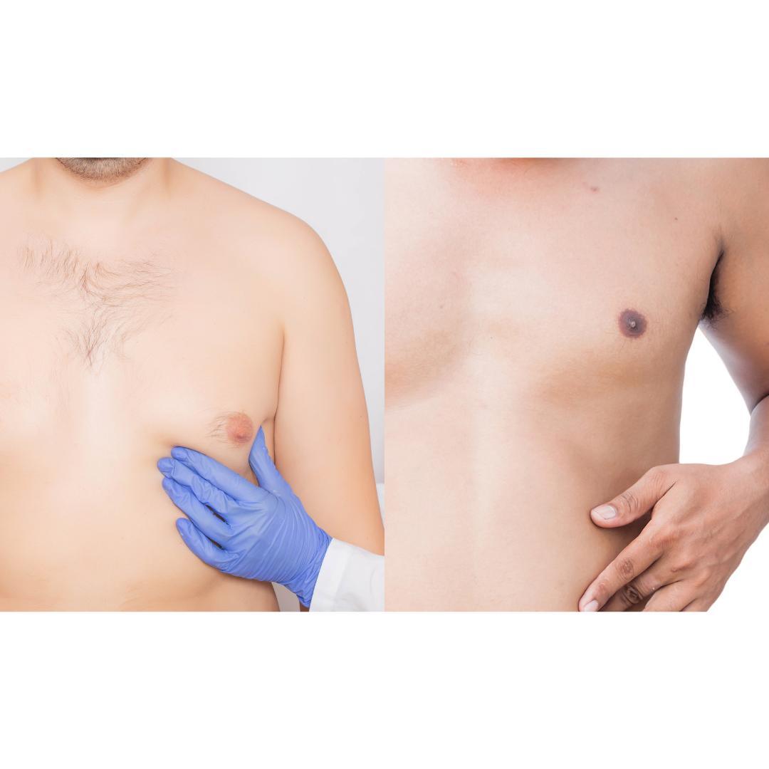 Gynecomastia Surgery